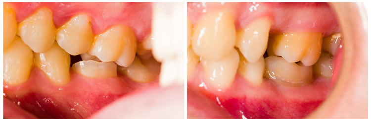 Zahnsteinentfernung im Seitenzahnbereich