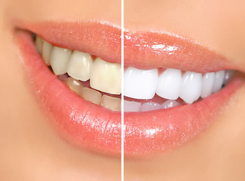 Die Aussicht auf schöne, weiße Zähne hilt die Angst vorm Zahnarzt zu überwinden